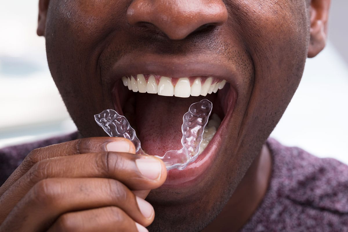 The Benefits Of Choosing Invisalign At Dentex Smile Studio Blog